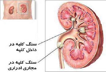 مصرف چاي سرد موجب ايجاد سنگ كليه مي شود