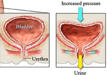 شيوع بي اختياري ادراري در زنان دو برابر مردان است