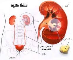 اگر یک کلیه دارید «ویتامین D» نخورید